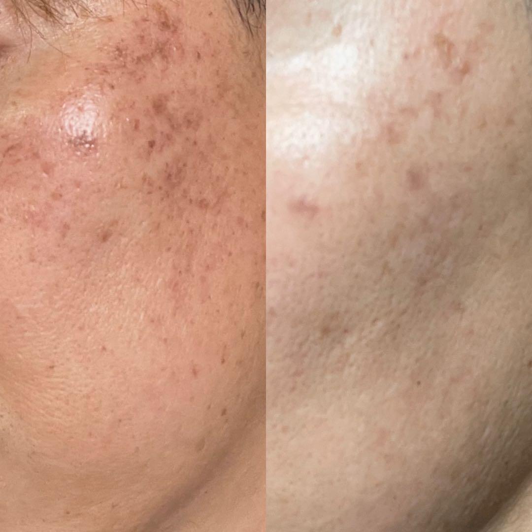 【容器キズ86%OFF】2個セットさらに割引 シミ取り美容液 レビウス シミ消し — image 3